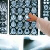 Los ictus se han convertido un enorme problema de salud silencioso en España. Y hay formas de limitar los riesgos